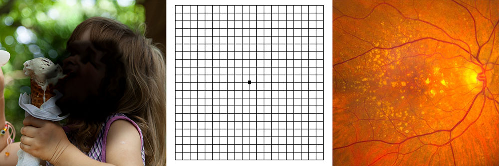 We test for macular degeneration on all patients with free digital imaging and amsler grid test.