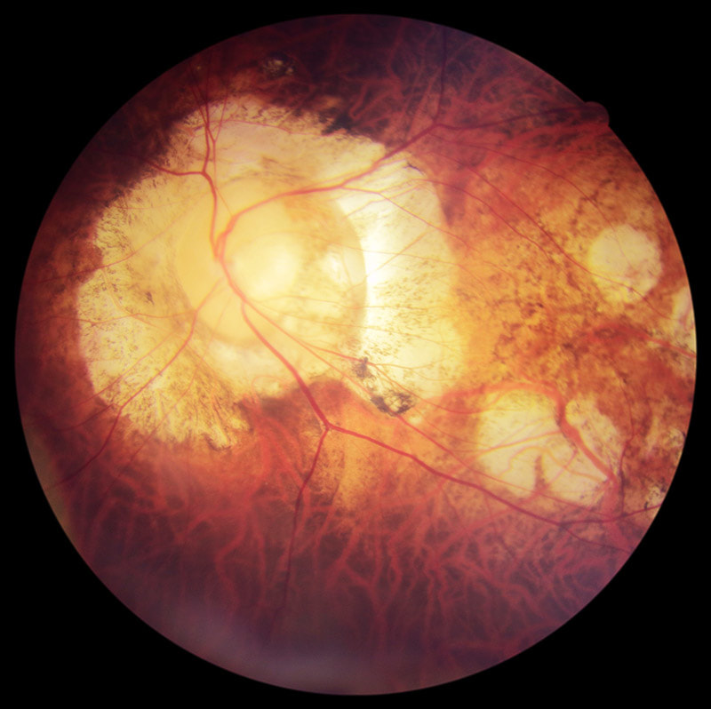 This patient with high myopia has developed vision loss from glaucoma and myopic macular degeneration associated with his myopia.