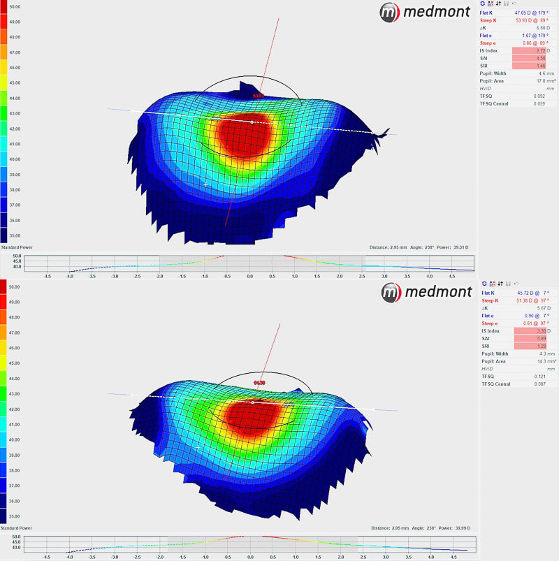 Corneal topography helps us diagnose and monitor cases of keratoconus and other diseases of the cornea.