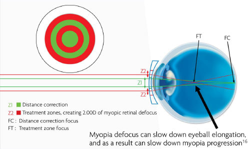 CooperVision MiSight 1 Day lenses feature special dual-focus optics. Available at Eyecare Concepts Myopia Clinic Melbourne.