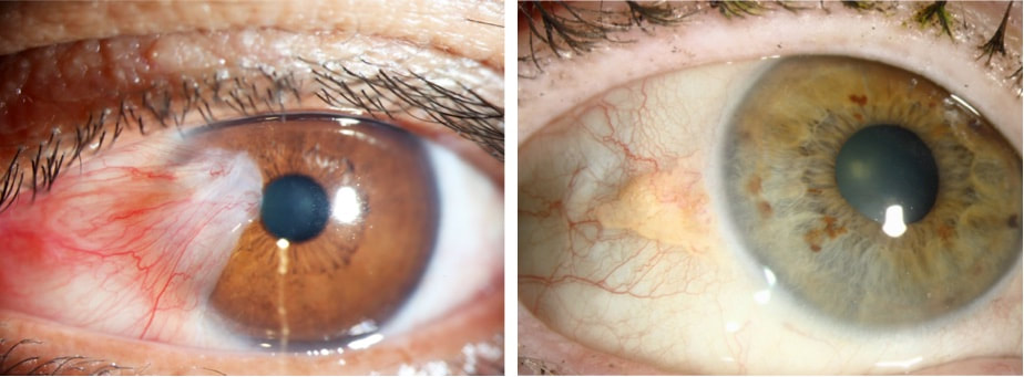 Left: Pterygium (growth extending over the cornea) vs Right: Pinguecula (growth stays on the white part of the eye)